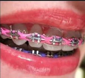 Braces Design Screenshot 3