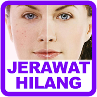 Cara Menghilangkan Jerawat
