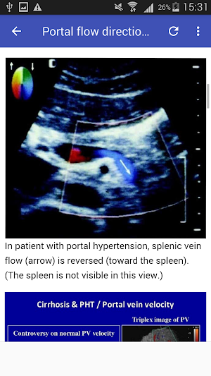 Portal hypertension Screenshot 2