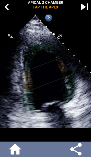 ECHO HEART WALL SEGMENTS QUIZ Screenshot 3