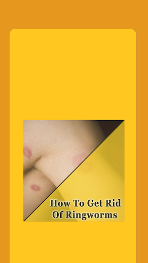 How To Get Rid Of Ringworms Screenshot 0