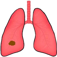 Lung TNM