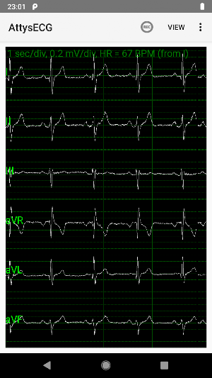 AttysECG Screenshot 1