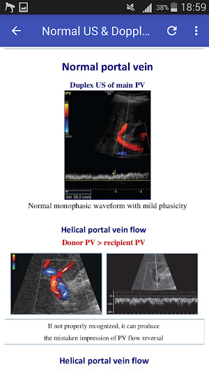 Doppler in Liver Transplant Screenshot 3