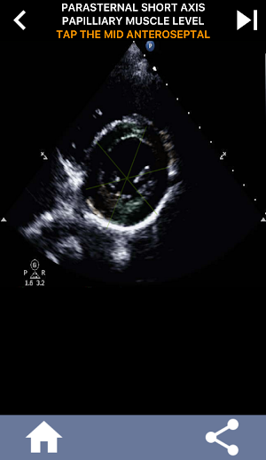ECHO HEART WALL SEGMENTS QUIZ Screenshot 2