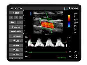 IBEX wireless ultrasound Screenshot 0