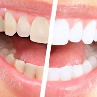 Teeth whitening resipes
