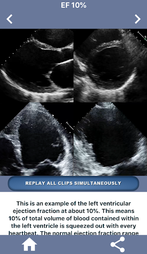 HEART EJECTION FRACTION: HOW TO EYEBALL THE EF Screenshot 1