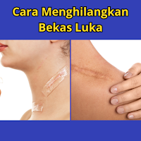 Cara Menghilangkan Bekas Luka