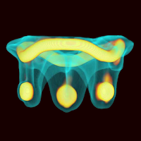 ViV Mitral