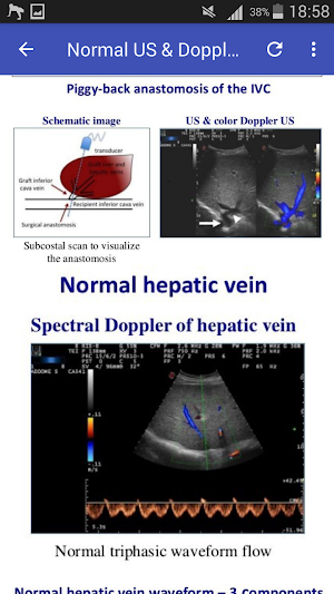 Doppler in Liver Transplant Screenshot 2