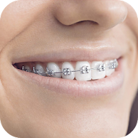 Teeth Braces Photo editor