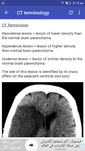 Stroke In CT Screenshot 0