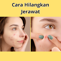 Cara Cepat Hilangkan Jerawat