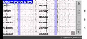 Cardiospy Mobile ECG Screenshot 2