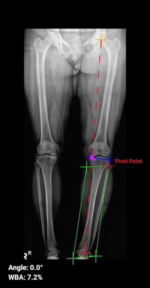 Osteotomy Plan Screenshot 1