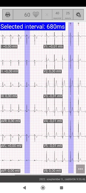 Cardiospy Mobile ECG Screenshot 3