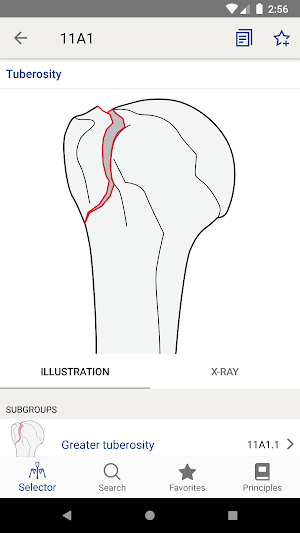 AO/OTA Fracture Classification Screenshot 3
