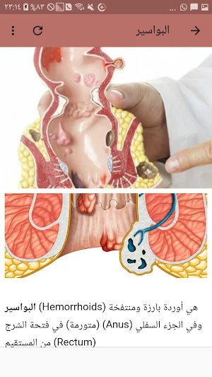 Hemorrhoids symptoms, causes and treatment Screenshot 2