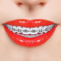 Braces Photo Editor