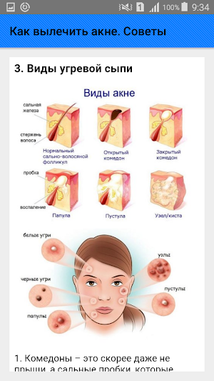 Как вылечить акне. Советы Screenshot 3