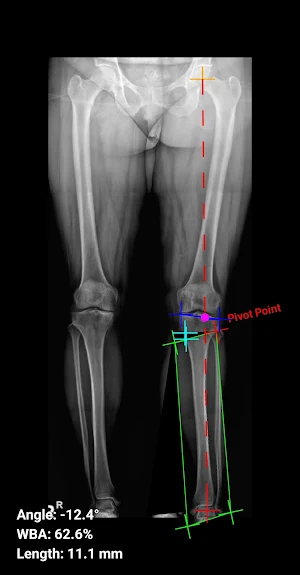 Osteotomy Plan Screenshot 2