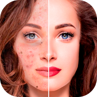 Blemishes Removal: beauty face camera