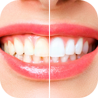teeth whitening