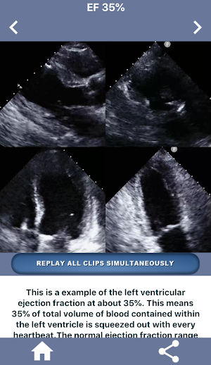 HEART EJECTION FRACTION: HOW TO EYEBALL THE EF Screenshot 2