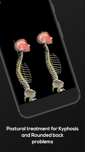 Kyphosis & Rounded Back by Muscle and Motion Screenshot 3