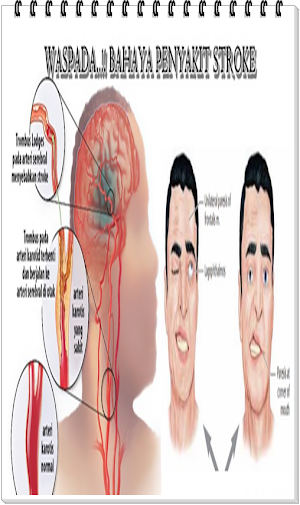 Cara Mengobati Stroke Ampuh Screenshot 3