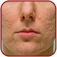 Acne Scar Removal