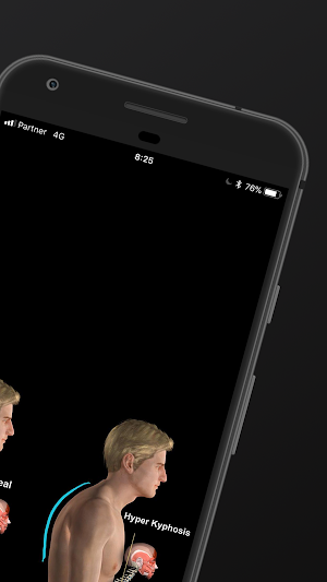 Kyphosis & Rounded Back by Muscle and Motion Screenshot 1