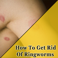 How To Get Rid Of Ringworms