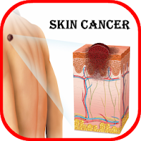 Skin Cancer