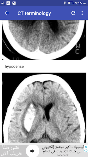 Stroke In CT Screenshot 1