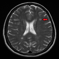 Multiple Sclerosis News