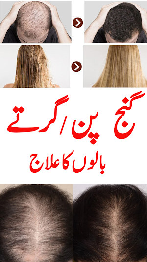 Balon k girny k ilaj-Hair loss Screenshot 2