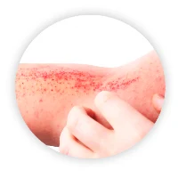 Managing Atopic Dermatitis