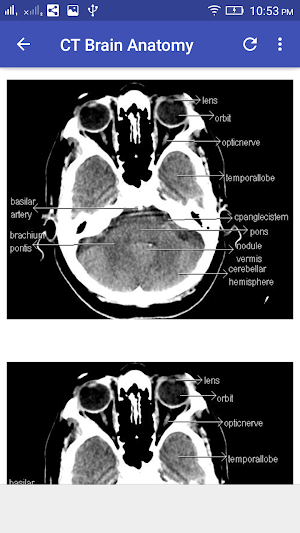 CT Brain Interpretation Screenshot 1