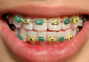 Braces Design Screenshot 1