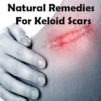 Natural Remedies For Keloid Sc