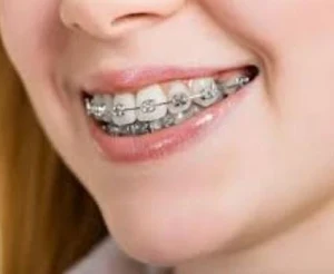 Braces Design Screenshot 2