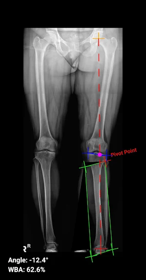 Osteotomy Plan Screenshot 3