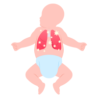 Neonatal Abstinence Syndrome