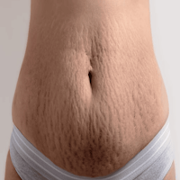 How to Get Rid of Stretch Mark