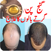 Balon k girny k ilaj-Hair loss