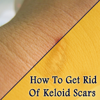 How To Get Rid Of Keloid Scars