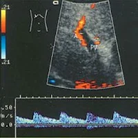 Portal hypertension