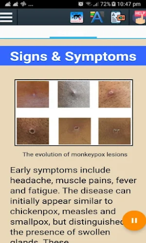 Monkeypox Info Screenshot 2